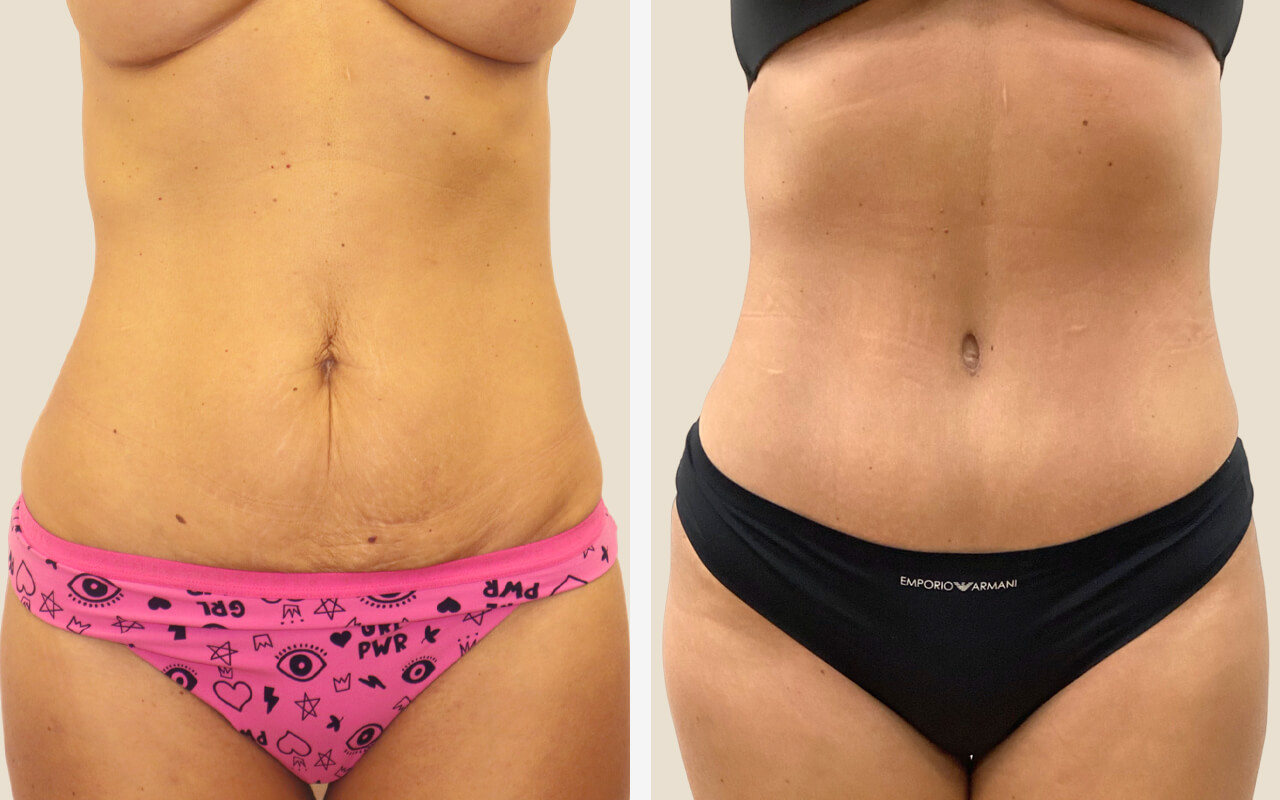 Abdominoplastika